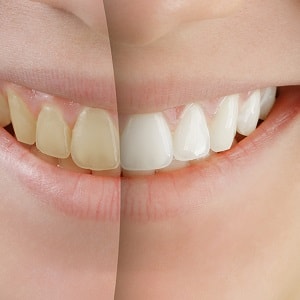 Teeth Whitening